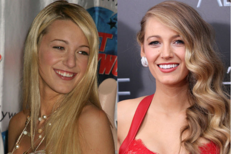 Celebrity Plastic Surgery Before And After Photos.